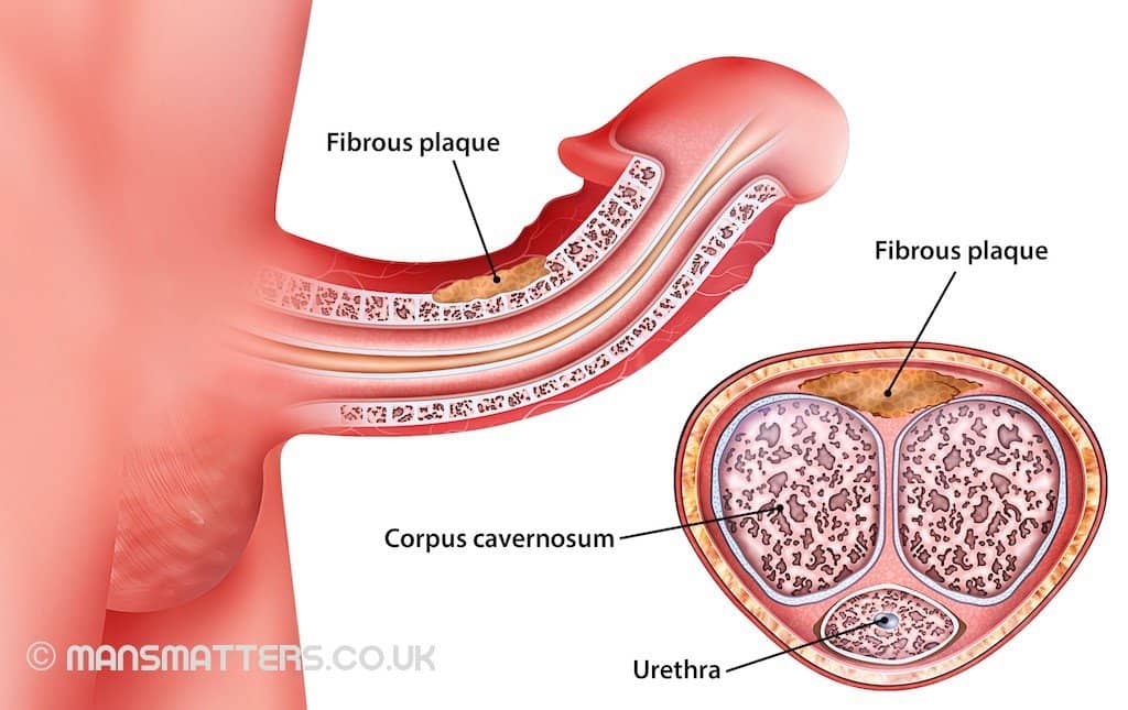 Natural ED Treatment: Keep an Erection without Drugs